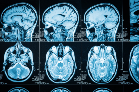 Kyste de l’épiderme dans le cerveau : le 1% qui change tout